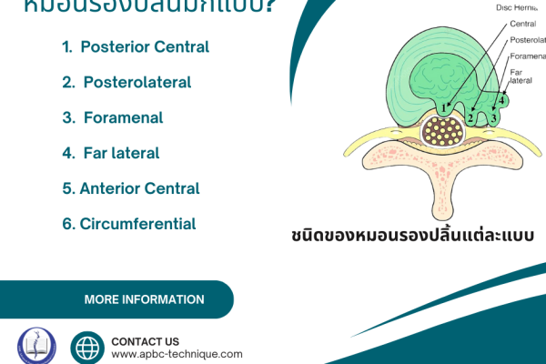 Read more about the article หมอนรองปลิ้นมีกี่แบบ